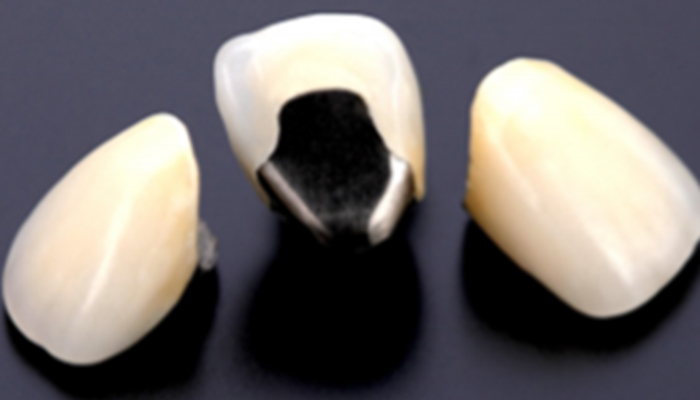 メタルボンド(セラミックス)