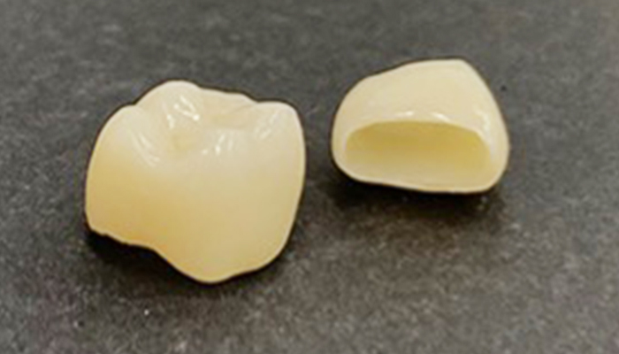 セレック(セラミックス)